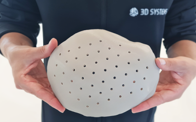 Les hôpitaux européens effectuent des chirurgies crâniennes à l’aide d’implants crâniens imprimés en 3D par 3D Systems