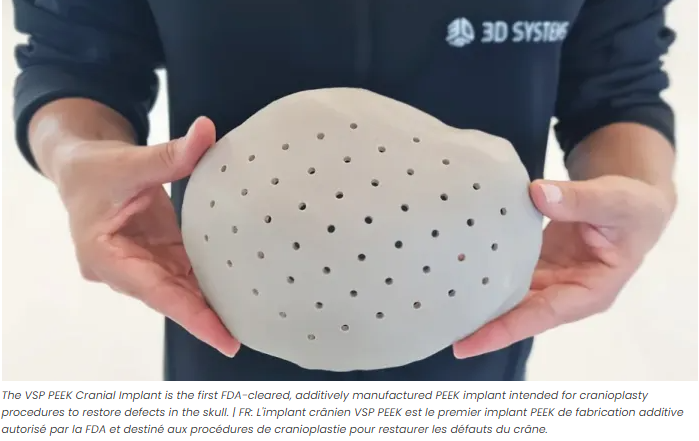 3D Systems reçoit l’autorisation de la FDA pour ses implants crâniens en PEEK imprimés en 3D