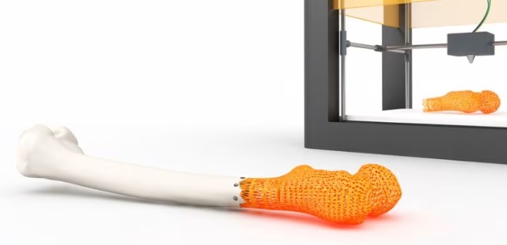 Impression 3D et orthopédie : vers des prothèses sur mesure